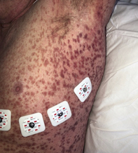 Fig 1a. Petechial rash.