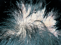 Fig 1. Scarring alopecia Fig 1. Scarring alopecia