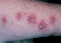 Fig 1. Pustular lesions