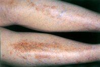 Fig 1. Pigmented patches
