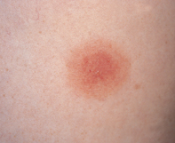Fig 1. Erythematous lesion Fig 1. Erythematous lesion