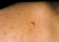 Fig 1. Pearly nodule