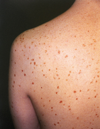 Fig 1. Red-brown lesions