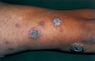 Fig 1. Crusted lesions Fig 1. Crusted lesions