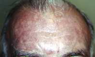 Fig 1. Slate-grey pigmentation